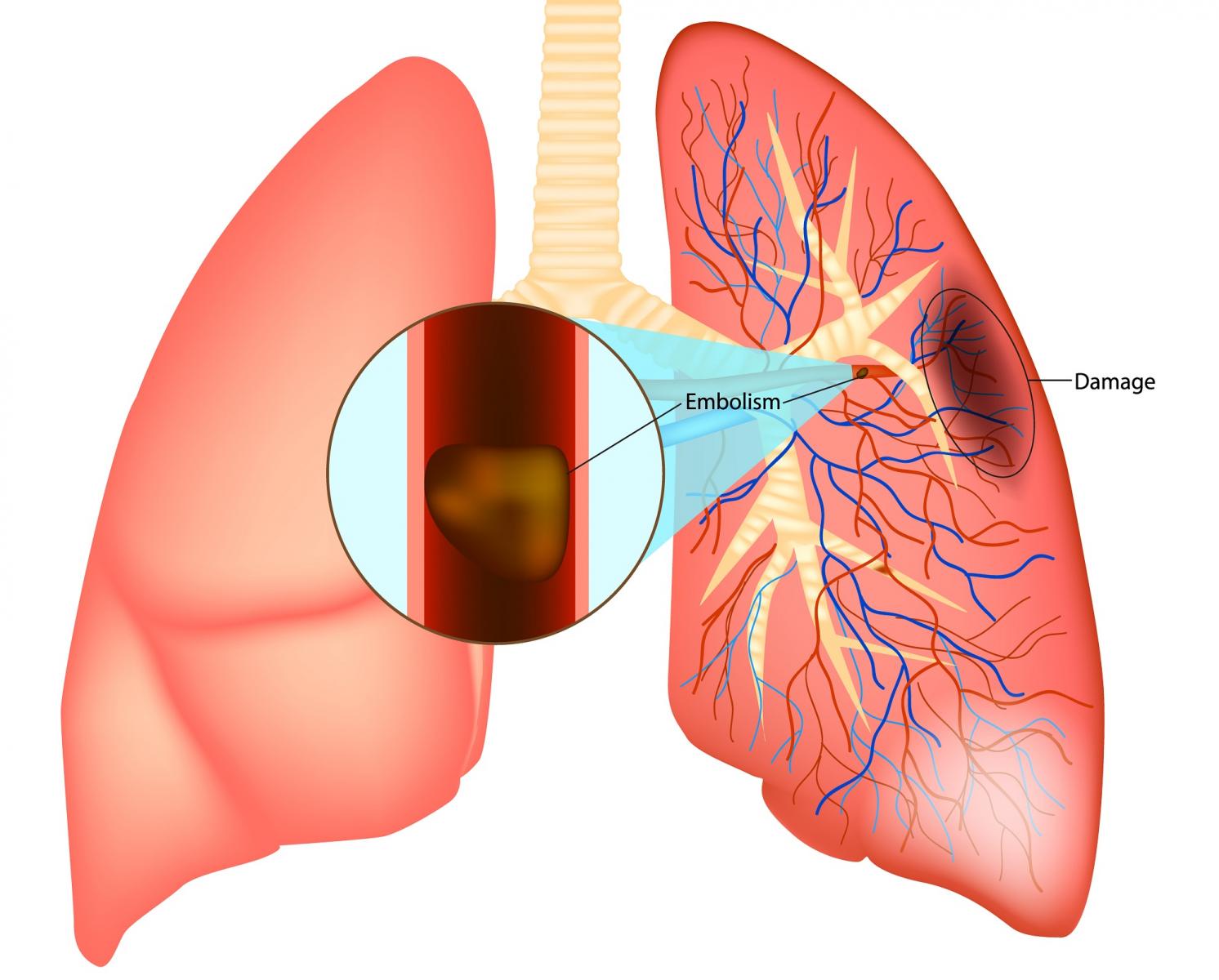 Thuyên tắc động mạch phổi nặng sẽ dẫn đến hôn mê, choáng, ngừng tim và tử vong.