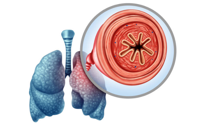 Đường dẫn khí của bệnh nhân COPD bị thu hẹp lại