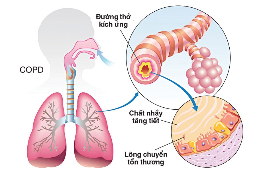 Năm 2004 có tới 64 triệu người mắc bệnh phổi tắc nghẽn mãn tính COPD