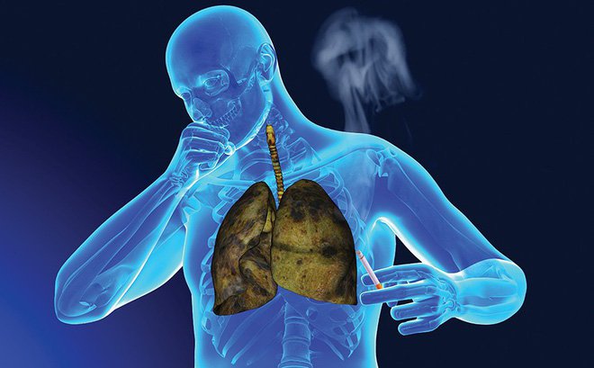 Ung thư phổi – biến chứng nguy hiểm của bệnh phổi tắc nghẽn mãn tính COPD