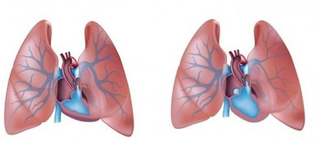 Phổi bình thường và phổi khi bị tăng áp lực động mạch phổi