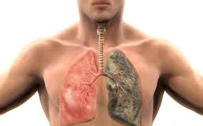 Nhiễm độc phổi - Nguyên nhân khiến tần suất cơn hen dày đặc hơn