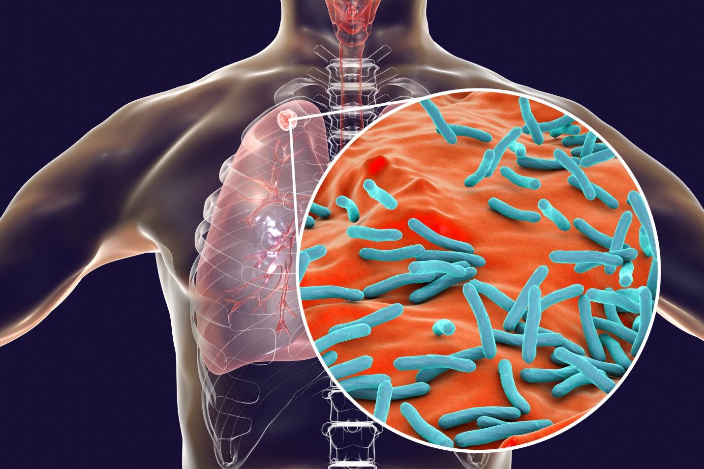 Khó thở về đêm có thể là dấu hiệu cảnh báo bệnh lao phổi 