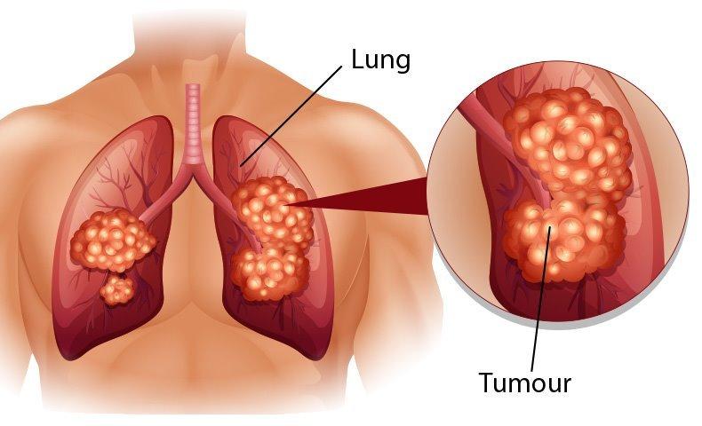 Khó thở về đêm có thể tiềm ẩn bệnh ung thư phổi