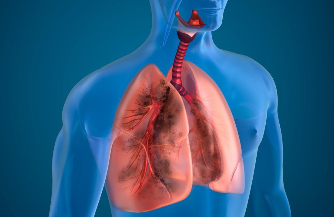 Nhiễm độc phổi là căn nguyên gây ra tình trạng khó thở về đêm