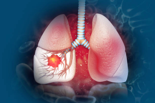 Nguyên nhân gây ung thư phổi là gì?