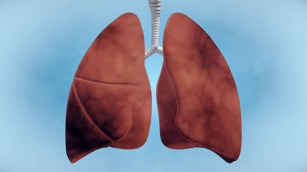 Nhiễm độc phổi là nguyên nhân gốc gây ung thư phổi