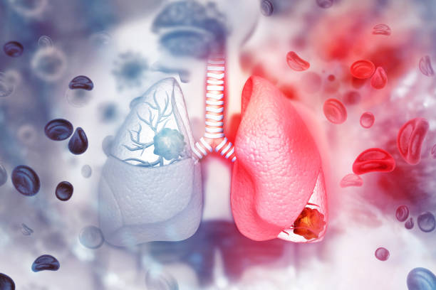 Dấu hiệu ung thư phổi thường gặp là gì?