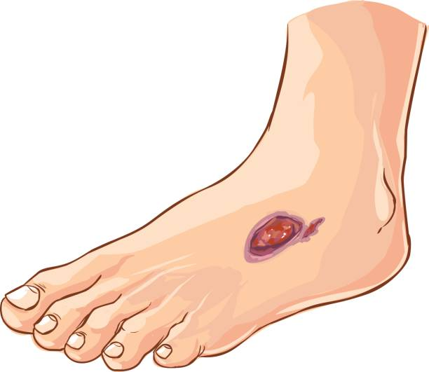  Biến chứng loét chân thường gặp ở bệnh nhân tiểu đường type 2