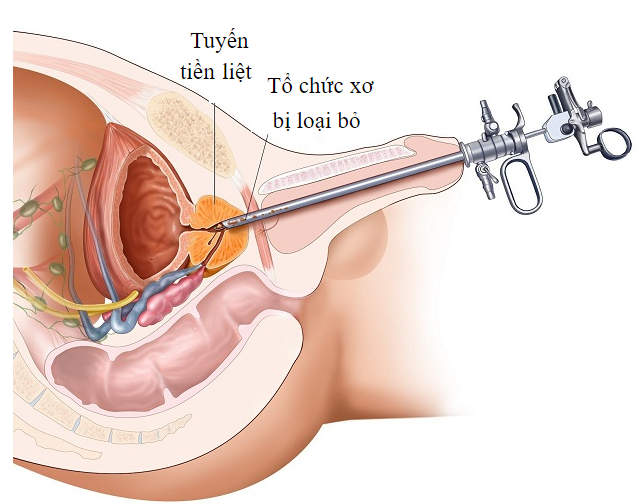 Phẫu thuật nội soi qua ống niệu đạo