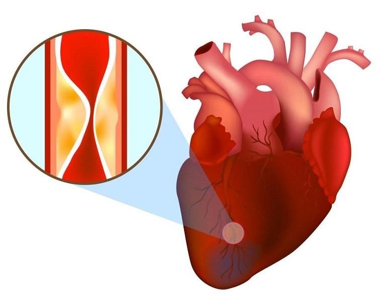 Biến chứng nhồi máu cơ tim ở bệnh tiểu đường