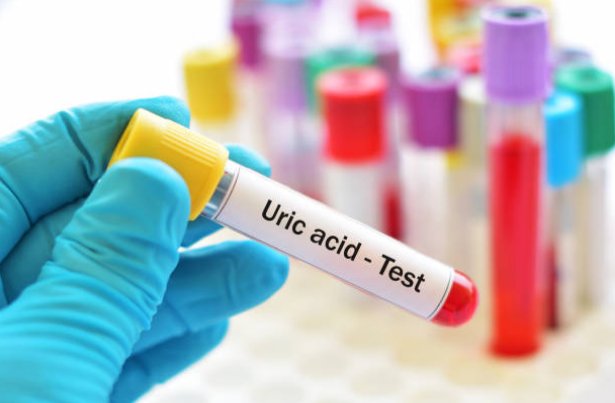 Xét nghiệm acid uric trong máu để chẩn đoán bệnh gút