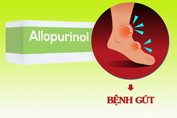  Allopurinol là thuốc thường được sử dụng trong điều trị bệnh gút