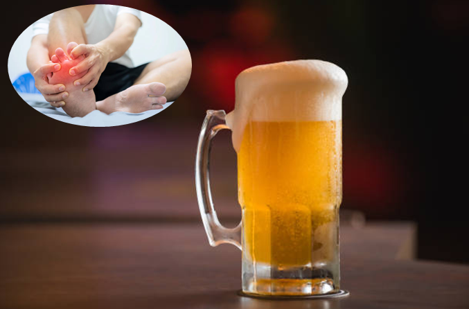 Các cơn gút cấp dễ bùng phát sau khi uống nhiều rượu bia