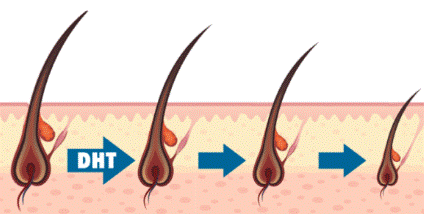 DHT - Nguyên nhân hàng đầu gây rụng tóc nhiều ở nam giới