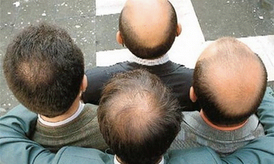 Rụng tóc nhiều ở nam giới do di truyền