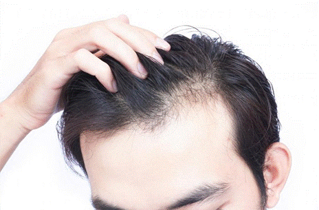 Rụng tóc nhiều ở nam giới là tình trạng như thế nào?