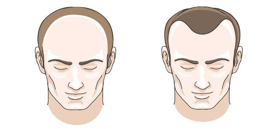 2 Kiểu hói đầu điển hình ở nam giới