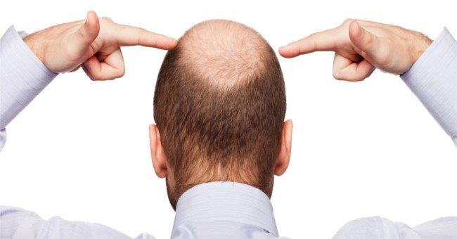 Nguyên nhân, dấu hiệu và cách chữa trị hói đầu là gì?