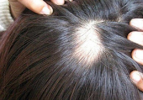  Tóc rụng thành từng mảng, lộ da đầu là biểu hiện của rụng tóc nhiều