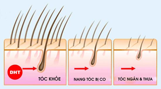 DHT- Nguyên nhân chính gây ra tình trạng tóc yếu dễ rụng ở nam giới