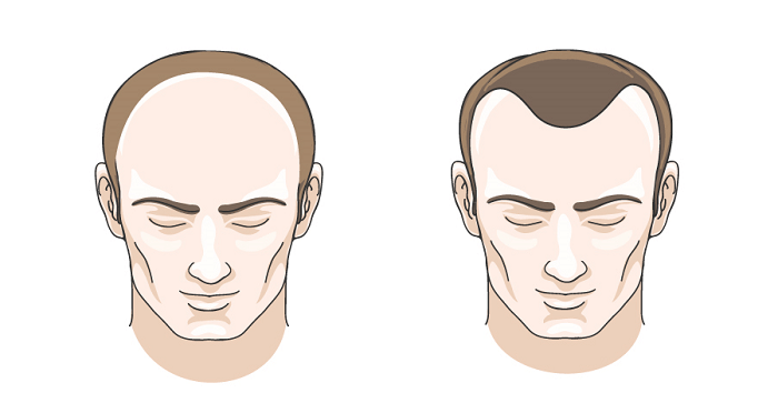 Hai kiểu rụng tóc thường gặp ở nam giới