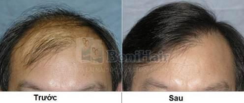 Mái tóc của chú Nguyễn Đình Thiết trước và sau khi dùng BoniHair