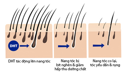 DHT tác động vào nang tóc gây rụng tóc nhiều, hói đầu sớm