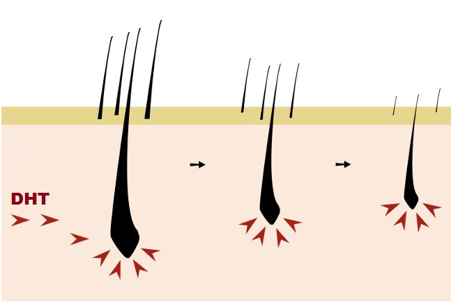 DHT là thủ phạm hàng đầu gây da đầu nhờn rụng tóc