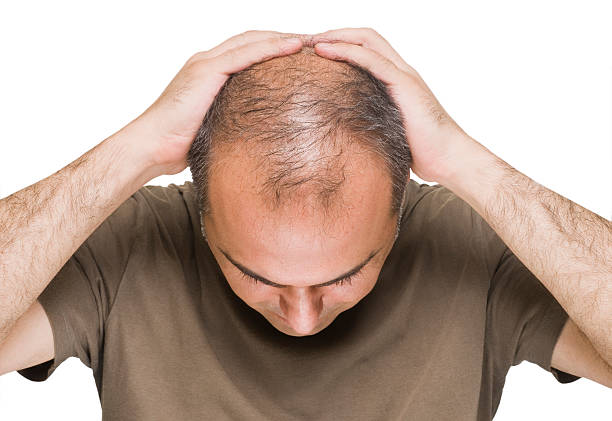 Suy giảm Testosterone làm tăng nguy cơ hói đầu ở nam giới