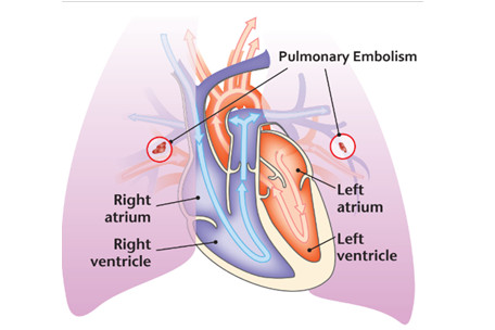 Thuyên tắc mạch phổi là biến chứng nguy hiểm nhất của bệnh suy giãn tĩnh mạch