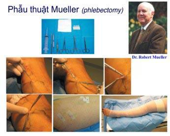 Phương pháp phẫu thuật Muller
