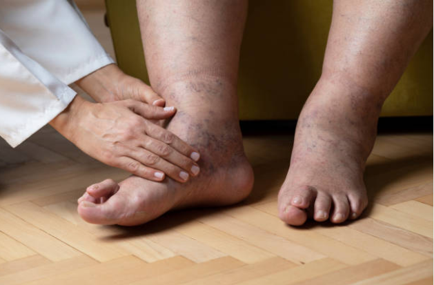 Phù chân là biểu hiện thường gặp của bệnh suy giãn tĩnh mạch