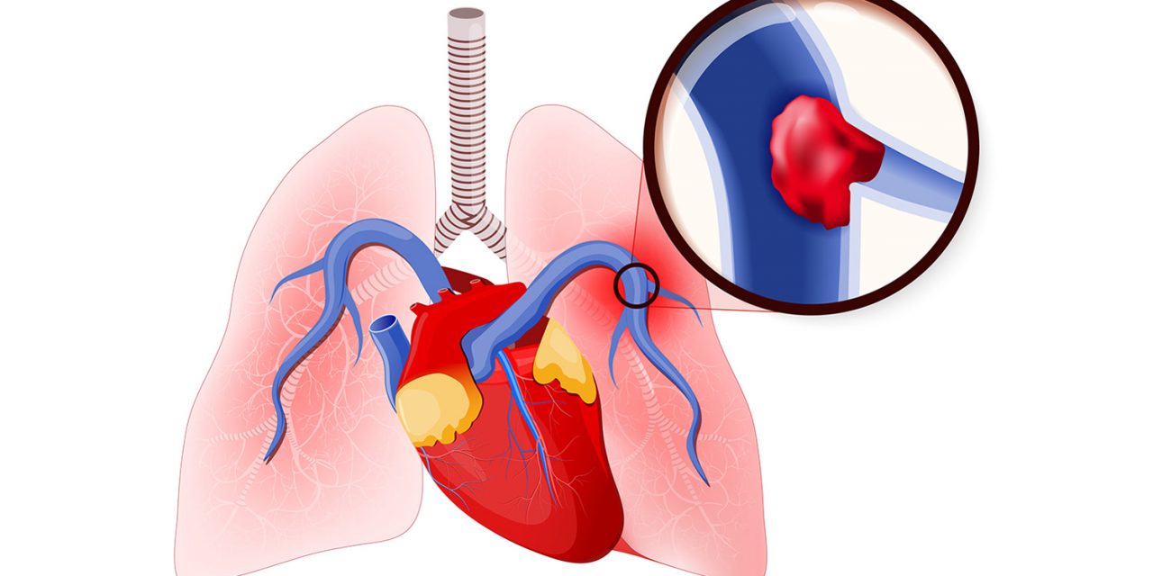  Thuyên tắc mạch phổi do huyết khối tĩnh mạch rất nguy hiểm