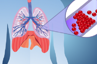 Thuyên tắc mạch phổi là biến chứng  nguy hiểm của bệnh