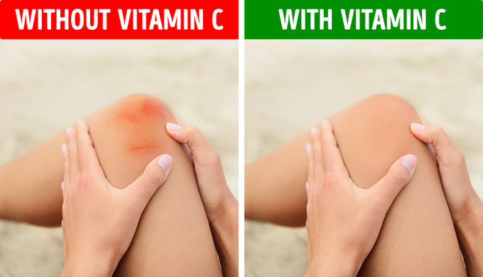 Cơ thể thiếu hụt vitamin C rất dễ xuất hiện các vết thâm tím trên da