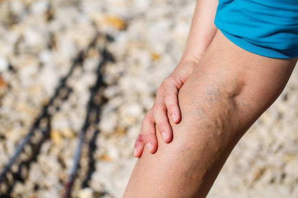 Giãn tĩnh mạch xảy ra phổ biến nhất ở chân