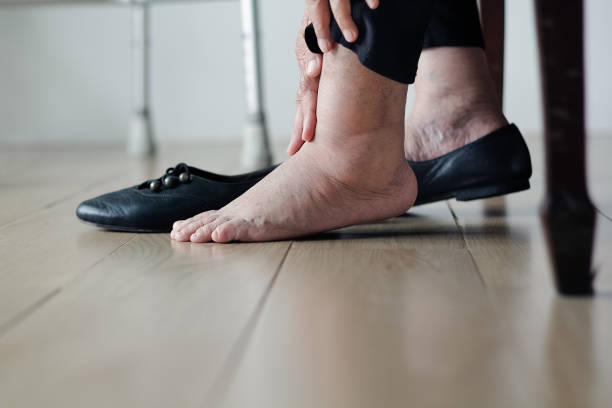  Sưng phù chân - Triệu chứng thường gặp ở người bệnh suy giãn tĩnh mạch sâu chi dưới