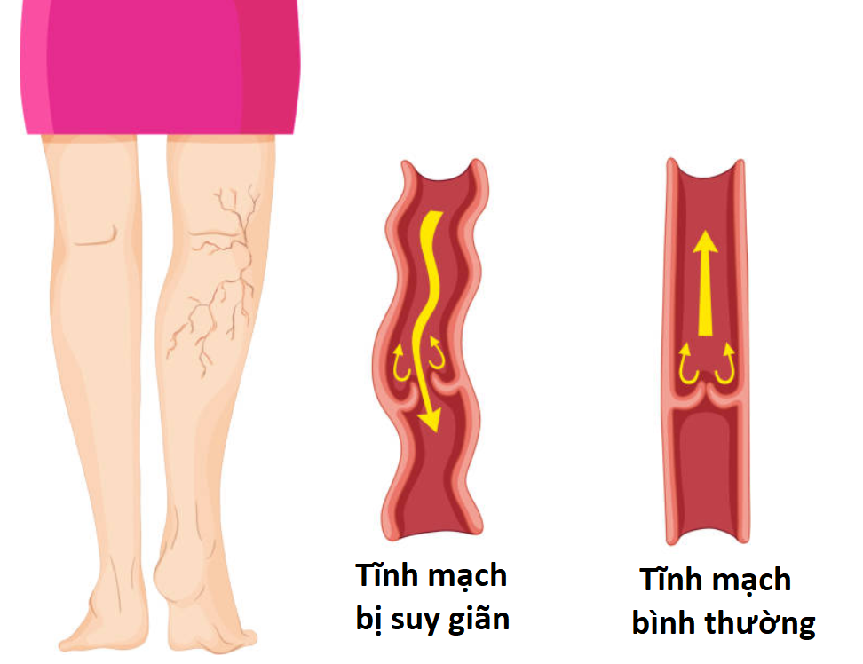 Bệnh suy giãn tĩnh mạch chân có đặc điểm điển hình là tĩnh mạch xanh tím nổi trên da
