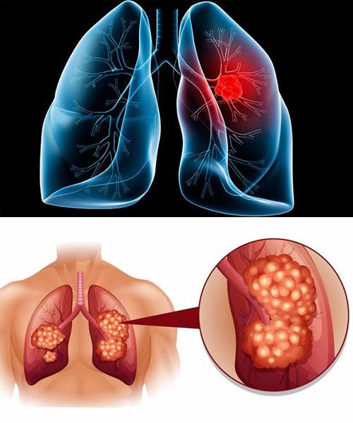 Thuốc lá điện tử là nguyên nhân gây ra hàng loạt các bệnh liên quan đến phổi