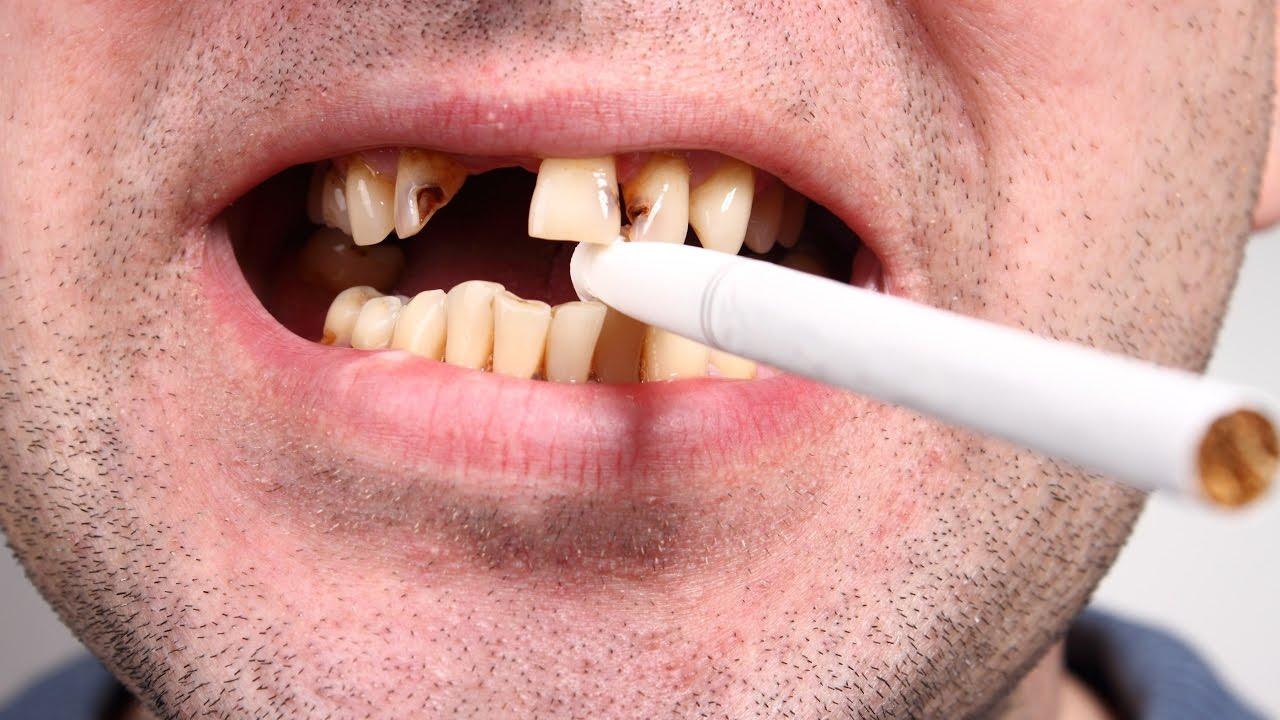 Hút thuốc lá làm tăng nguy cơ bị rụng răng