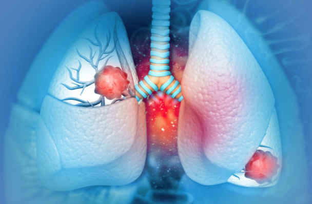 Khói thuốc lá gây ra hàng loạt các bệnh liên quan đến phổi