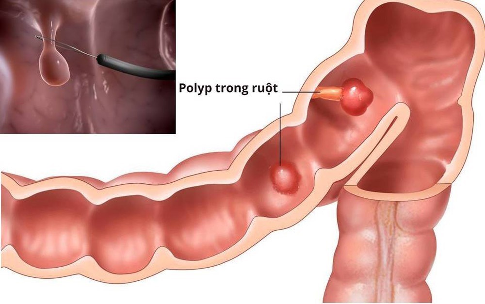 Bệnh polyp trực tràng: Triệu chứng, nguyên nhân và cách điều trị